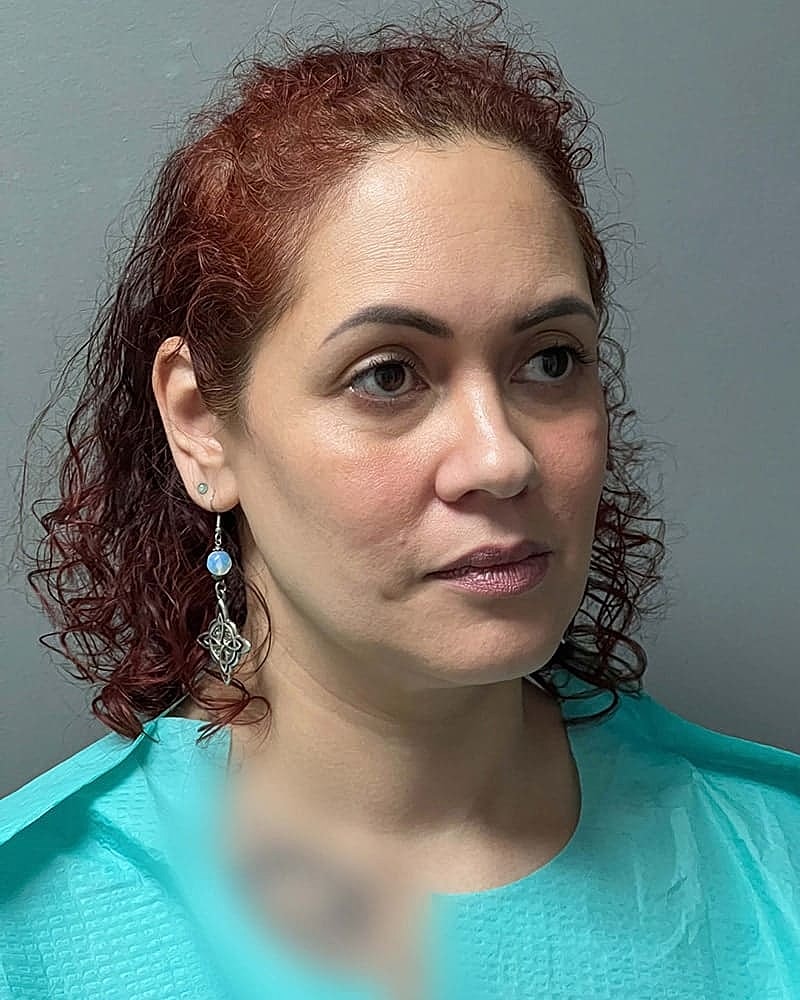 Chin Liposuction Before & After