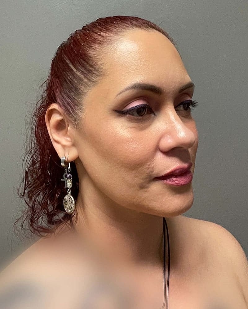 Chin Liposuction Before & After