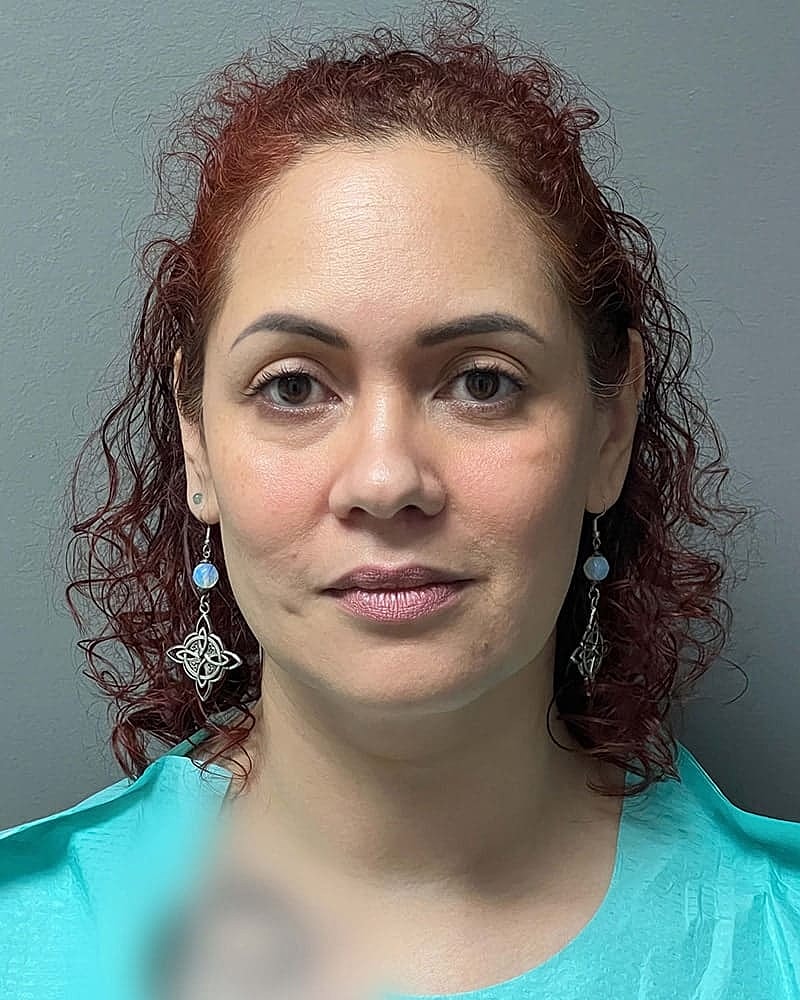 Chin Liposuction Before & After