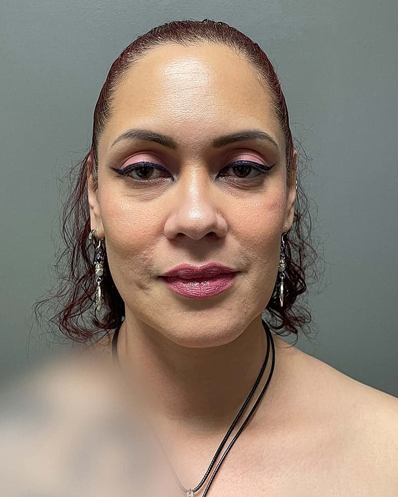Chin Liposuction Before & After