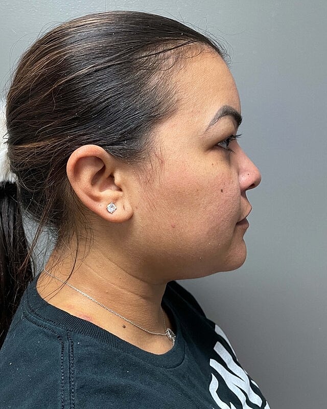 Chin Liposuction Before & After