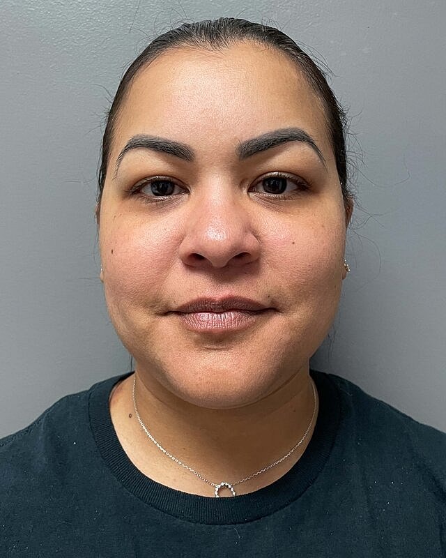 Chin Liposuction Before & After
