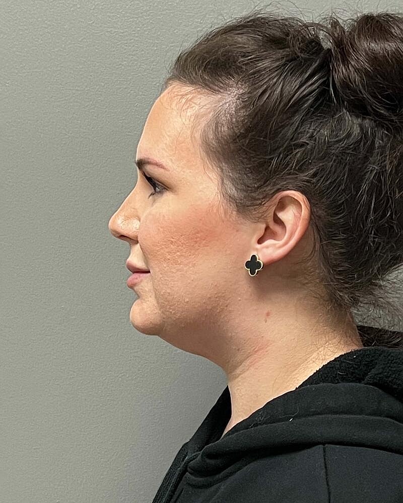 Chin Liposuction Before & After