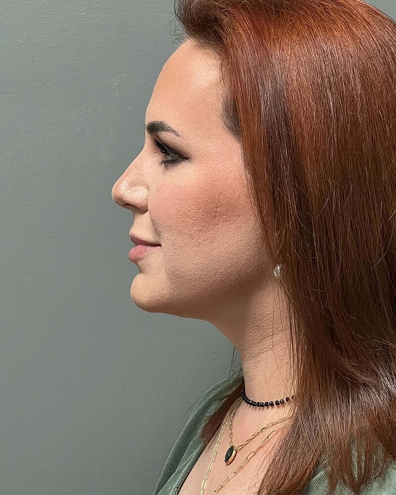 Chin Liposuction Before & After