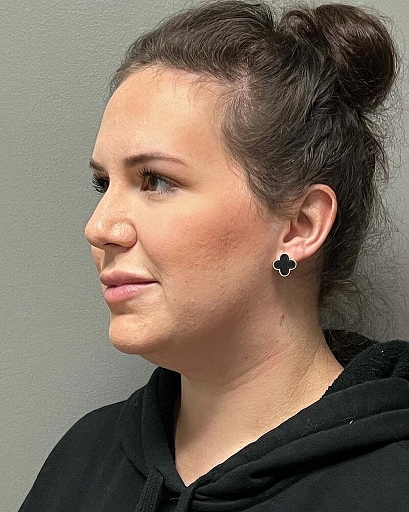 Chin Liposuction Before & After