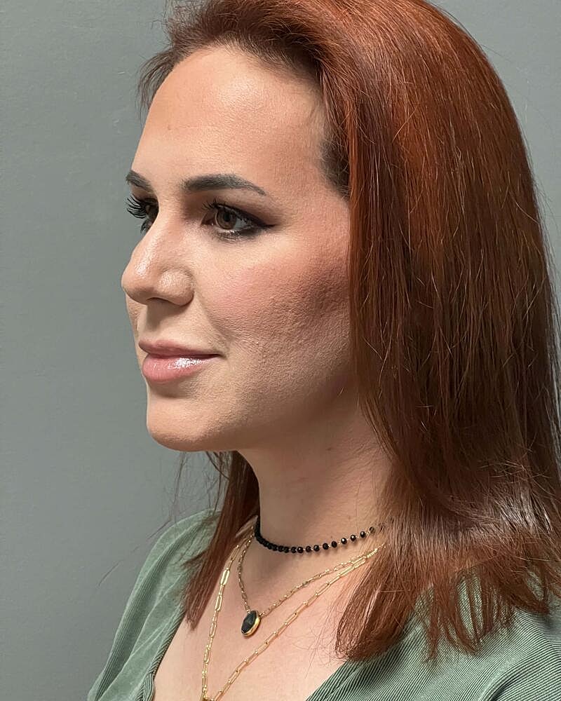 Chin Liposuction Before & After