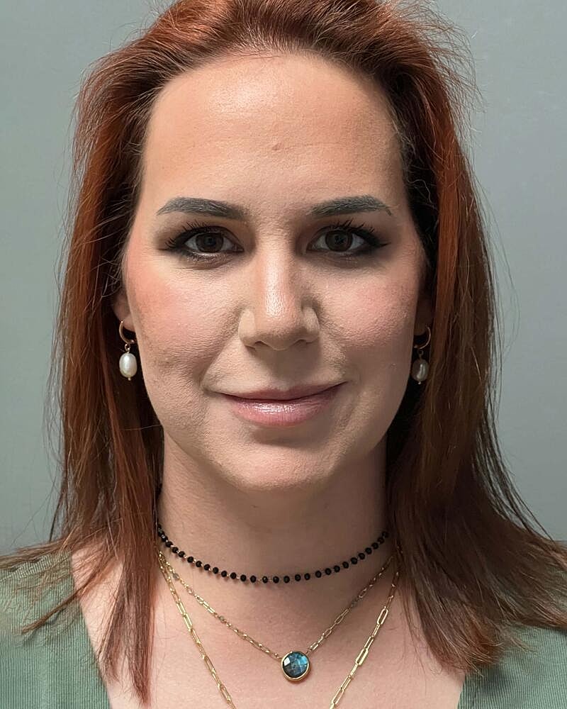 Chin Liposuction Before & After