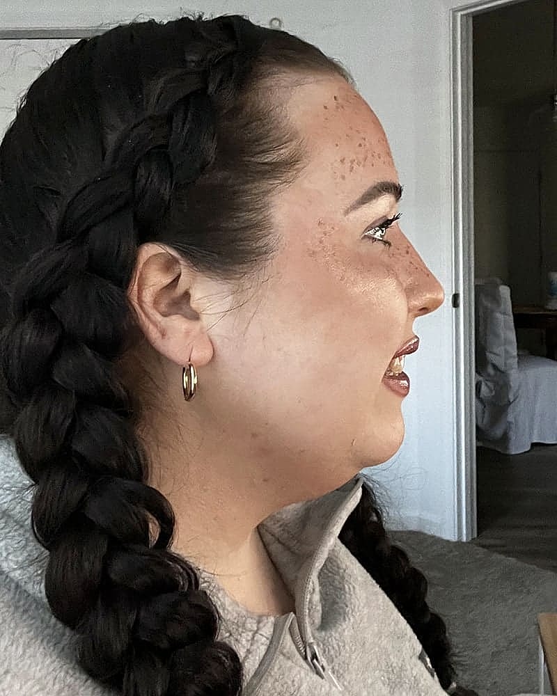 Chin Liposuction Before & After