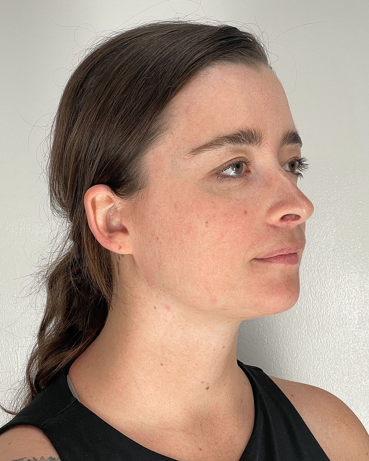 Chin Liposuction Gallery Before & After