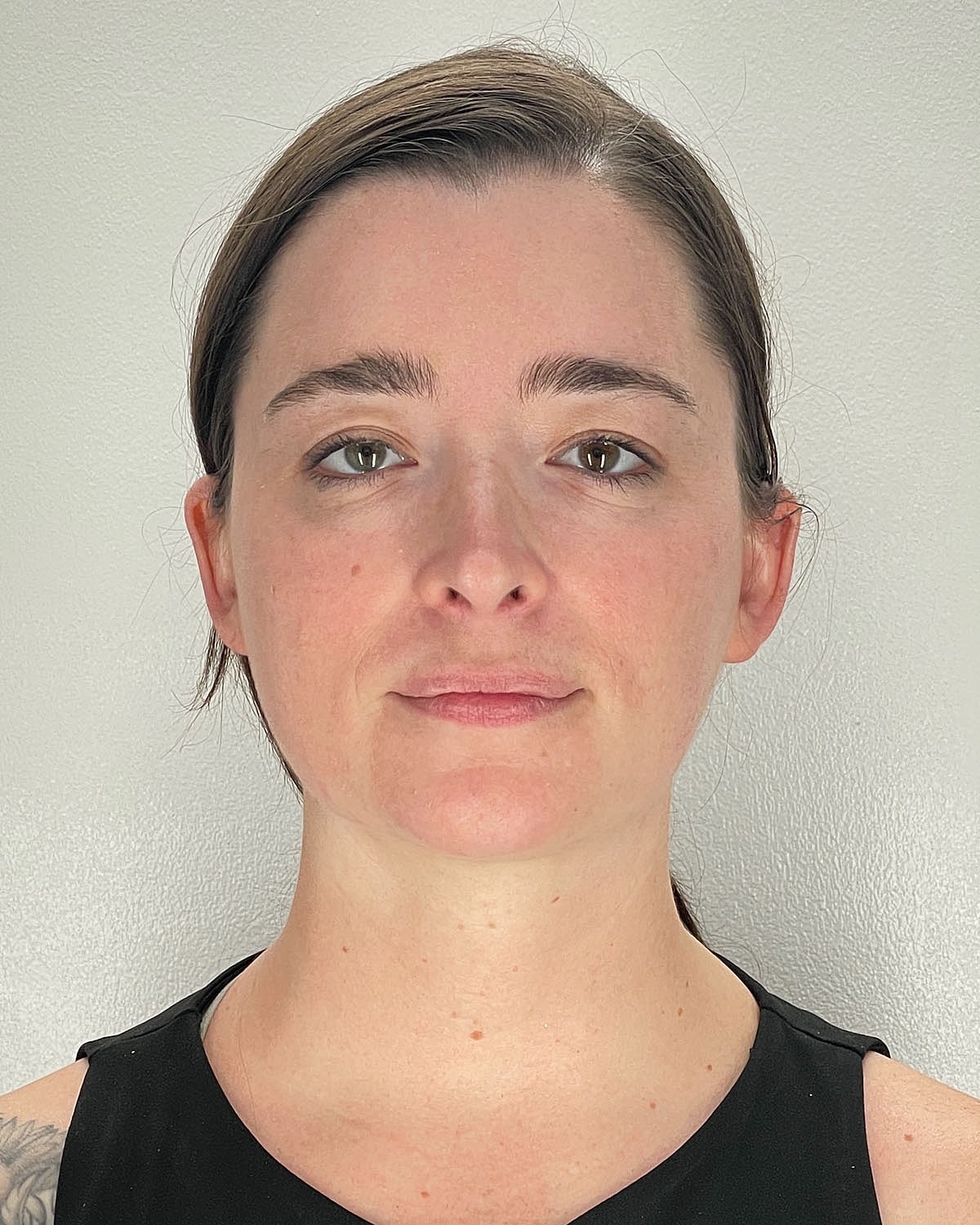 Chin Liposuction Gallery Before & After