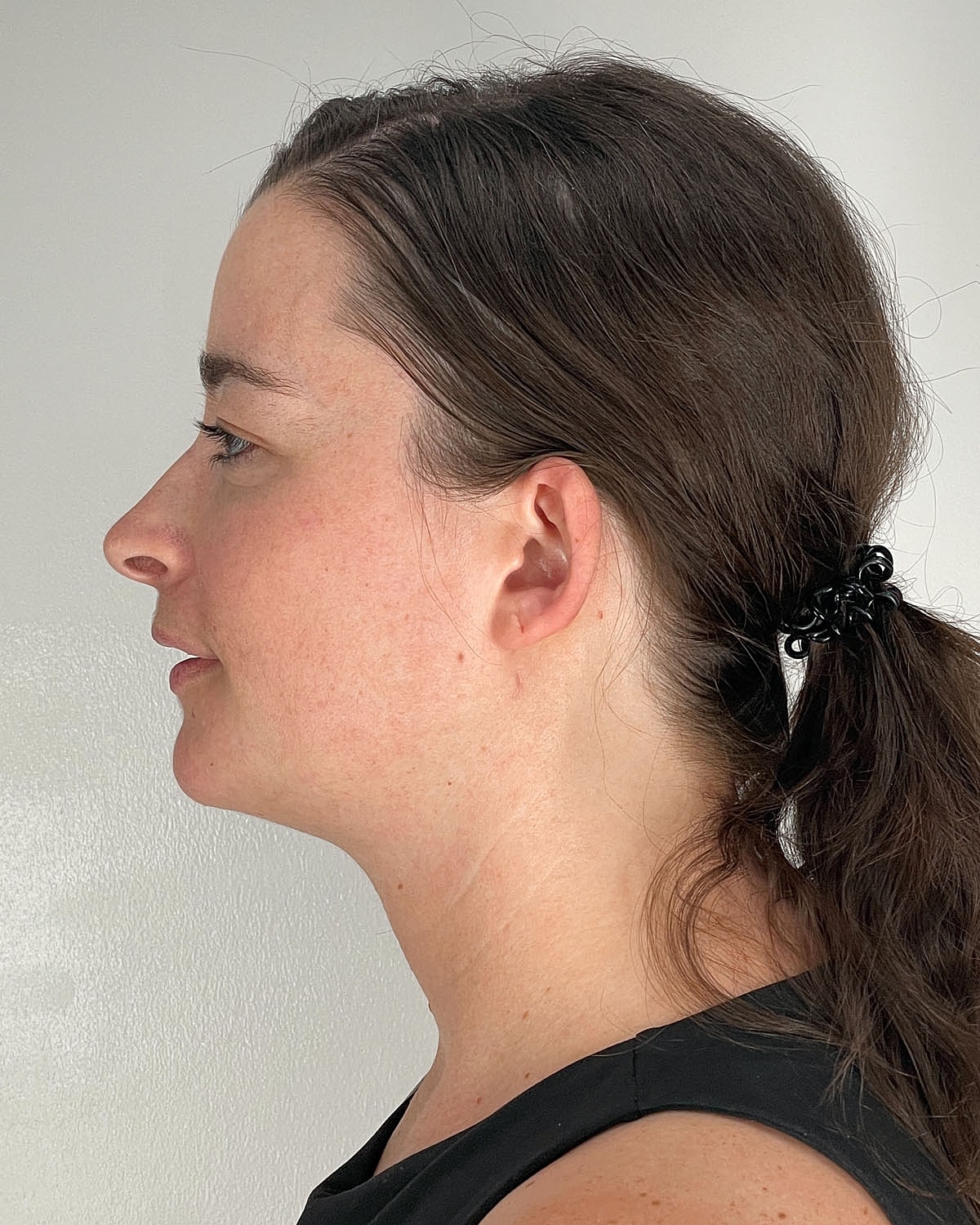 Chin Liposuction Gallery Before & After