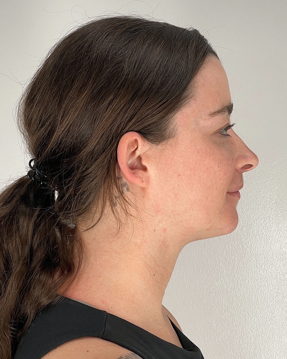Chin Liposuction Gallery Before & After