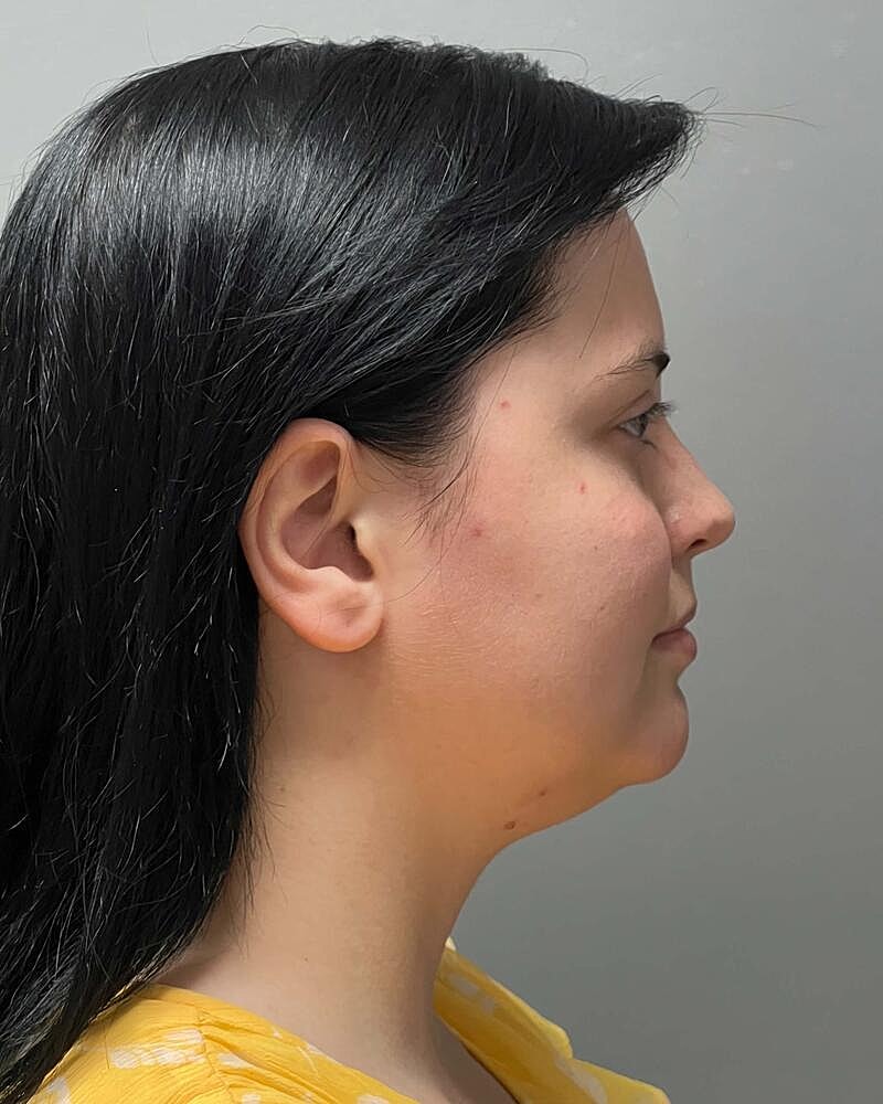 Chin Liposuction Before & After