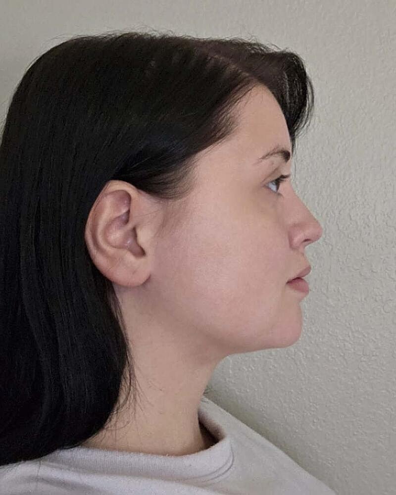 Chin Liposuction Before & After