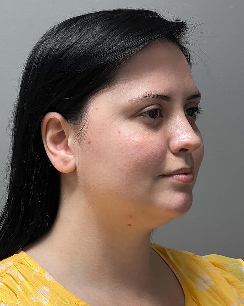 Chin Liposuction Before & After