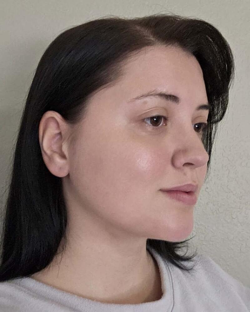 Chin Liposuction Before & After