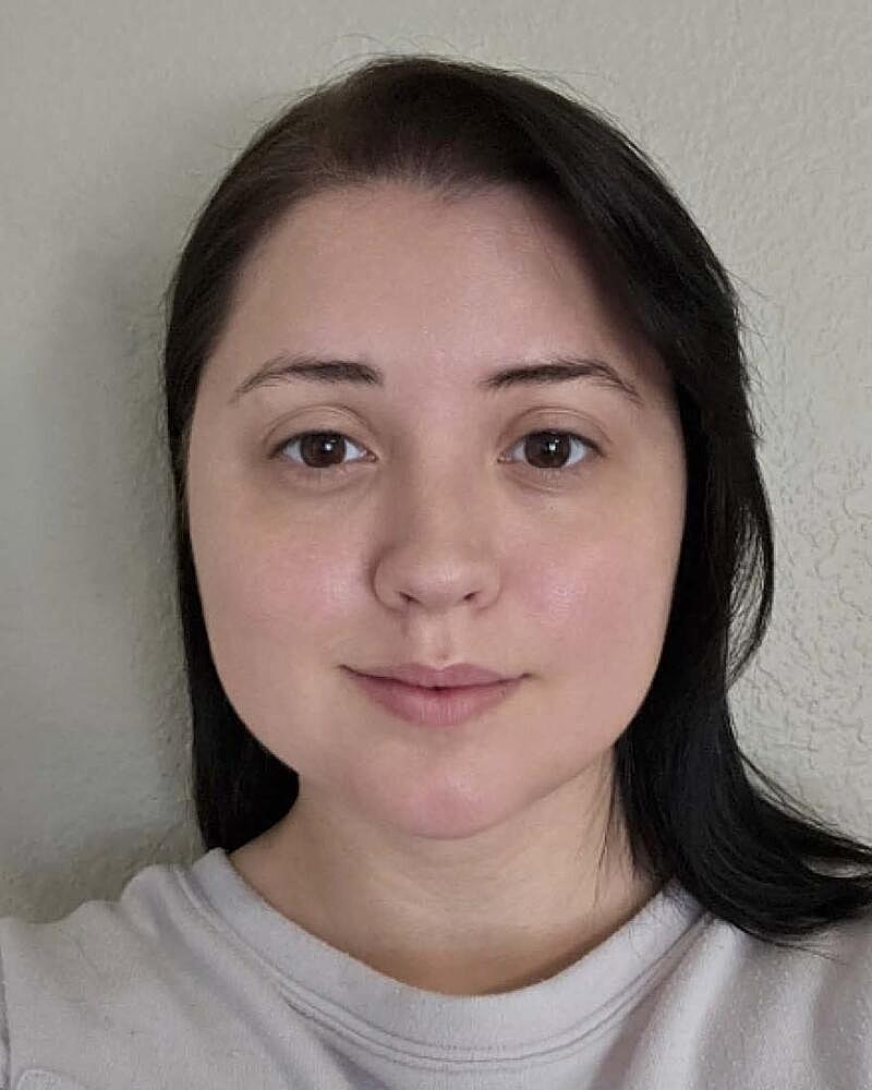 Chin Liposuction Before & After
