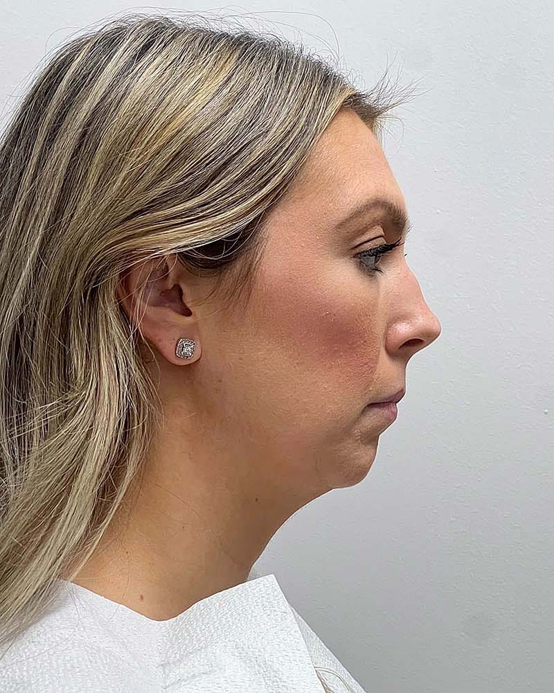 Chin Liposuction Before & After