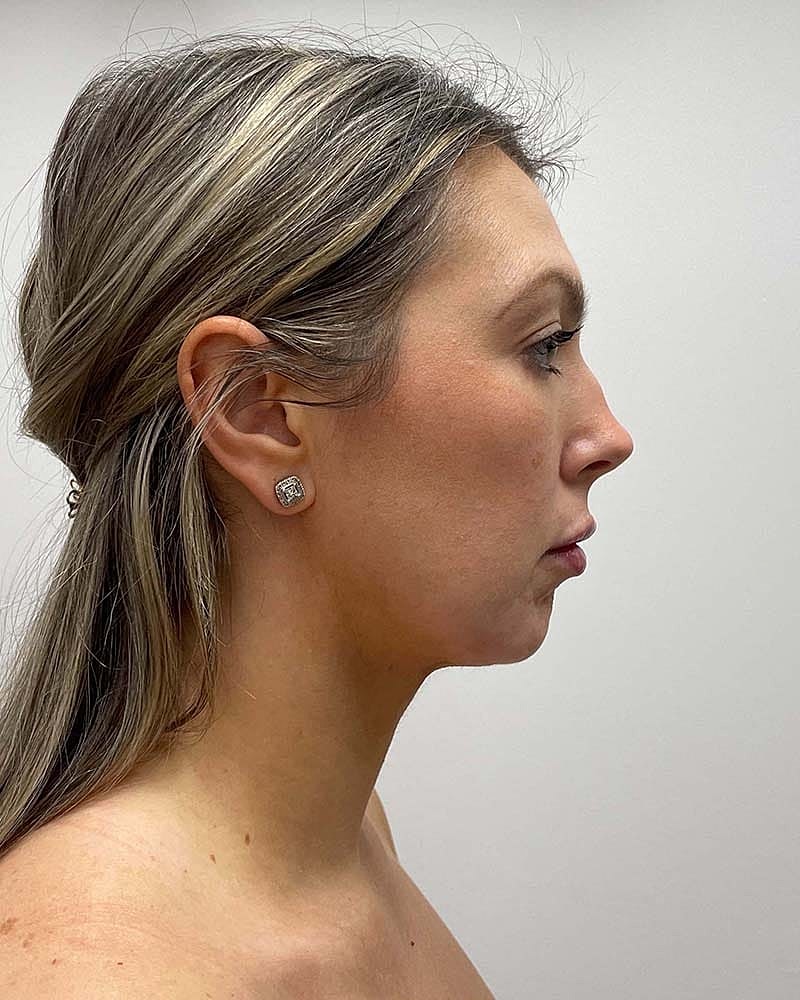 Chin Liposuction Before & After