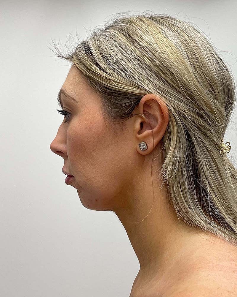 Chin Liposuction Before & After