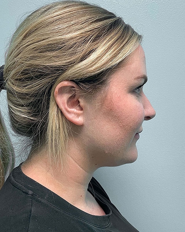 Chin Liposuction Before & After