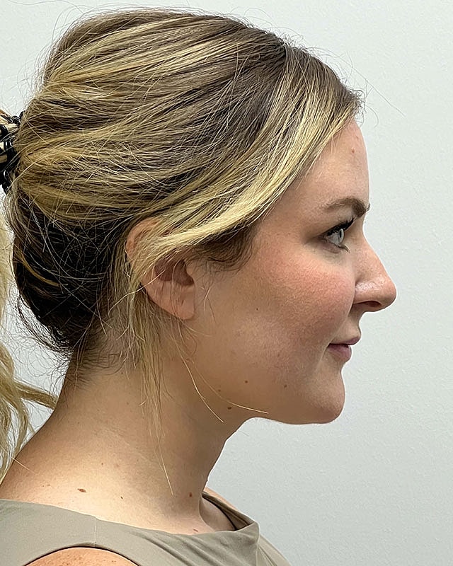 Chin Liposuction Before & After