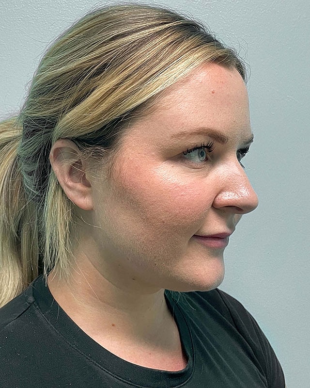 Chin Liposuction Before & After