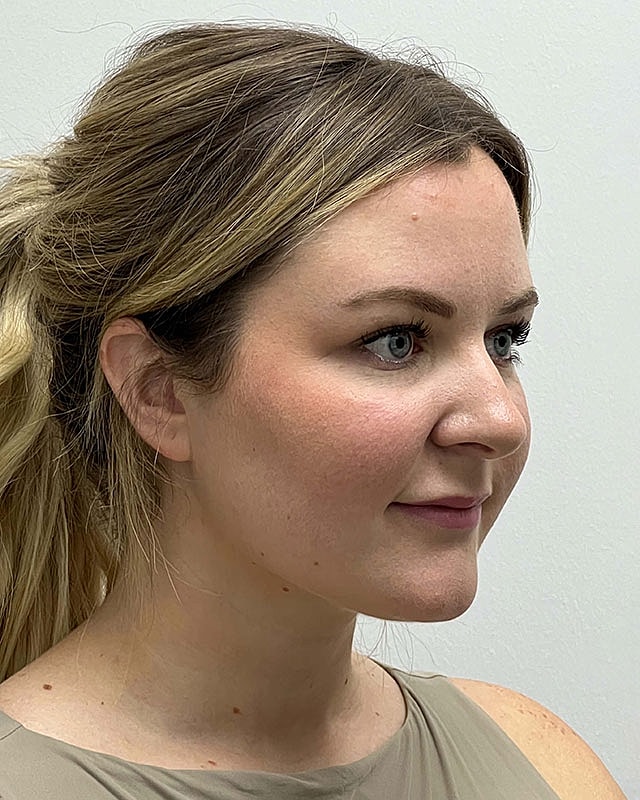Chin Liposuction Before & After