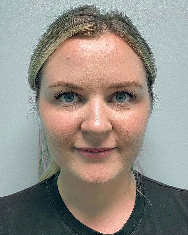 Chin Liposuction Before & After