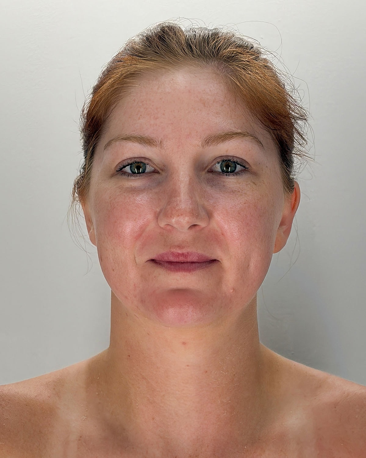 Chin Liposuction Gallery Before & After