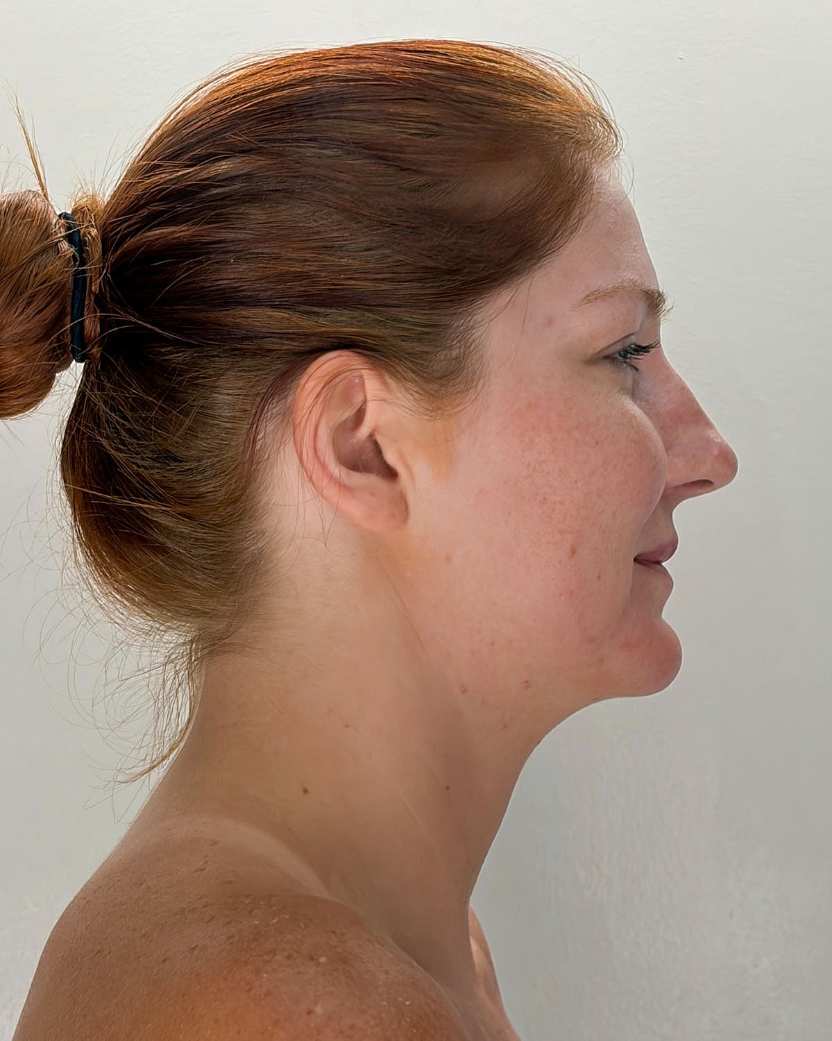 Chin Liposuction Gallery Before & After