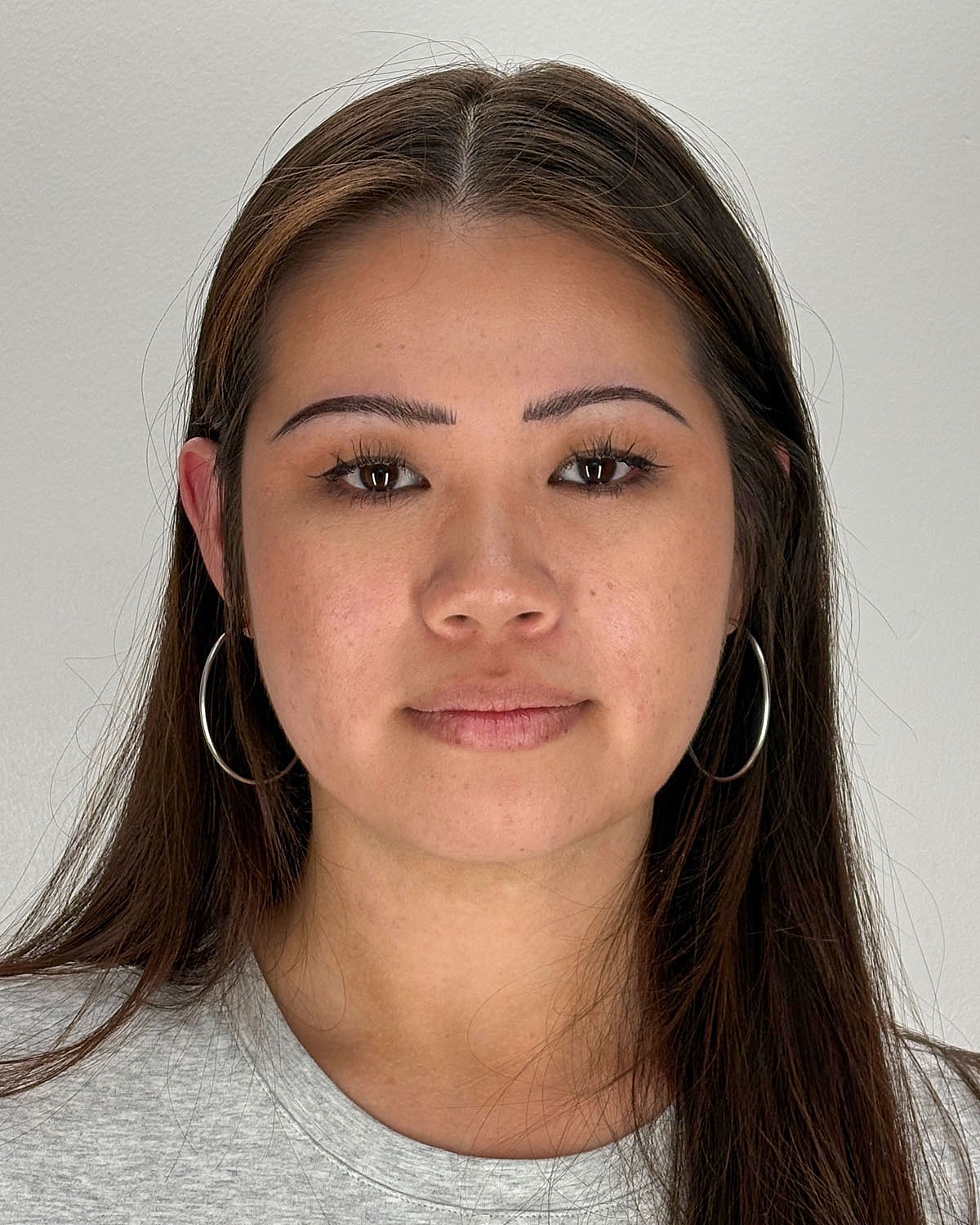 Chin Liposuction Gallery Before & After