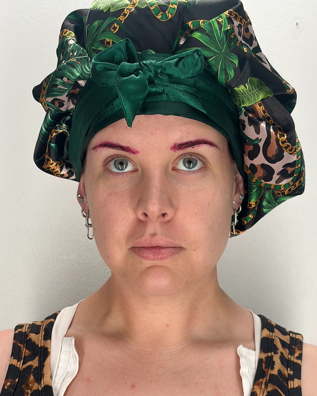 Chin Liposuction Gallery Before & After