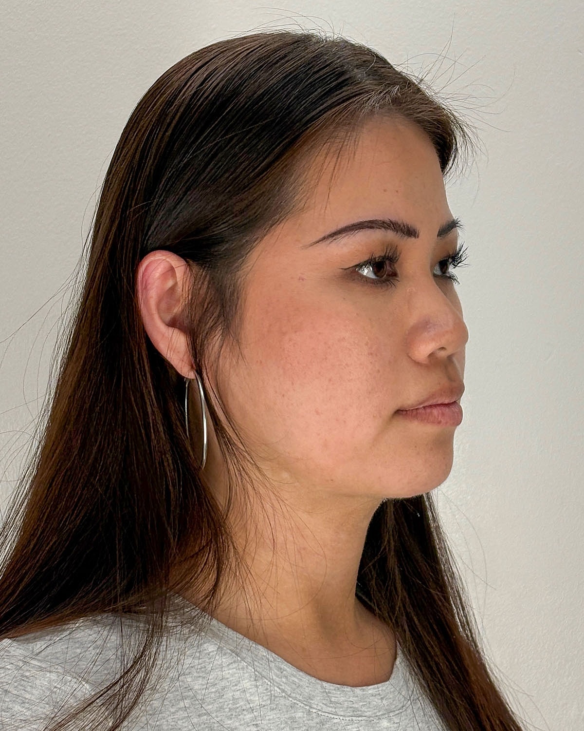 Chin Liposuction Gallery Before & After