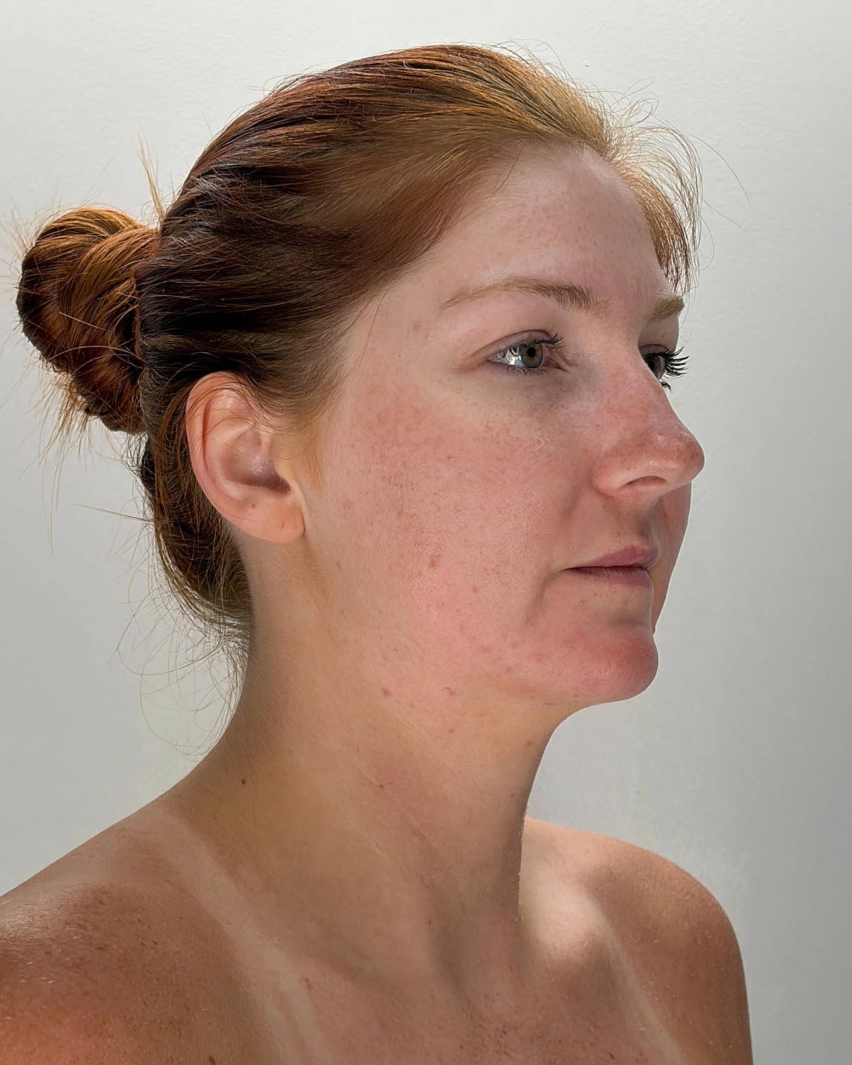 Chin Liposuction Gallery Before & After