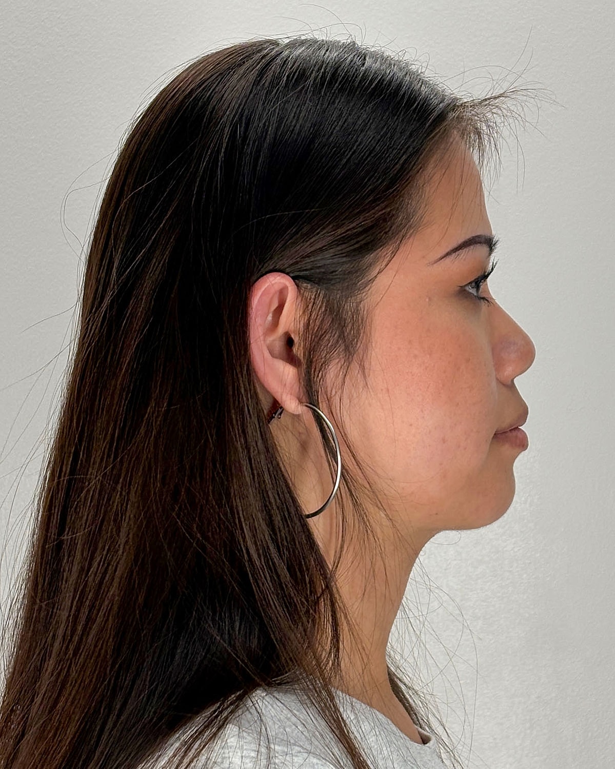 Chin Liposuction Gallery Before & After