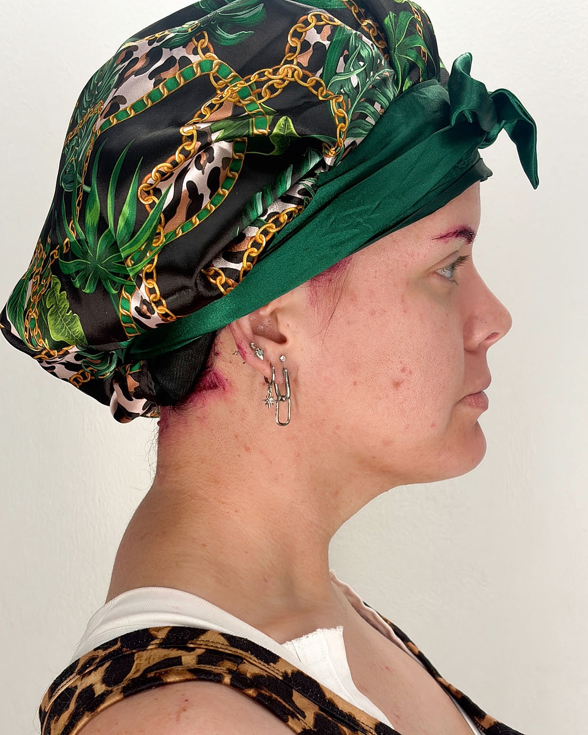 Chin Liposuction Gallery Before & After