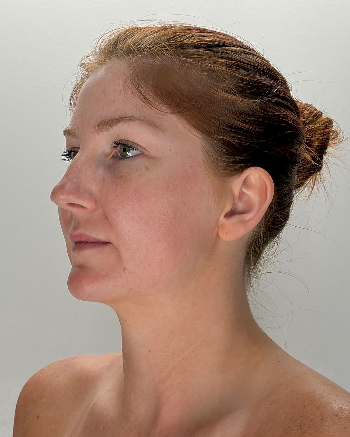 Chin Liposuction Gallery Before & After