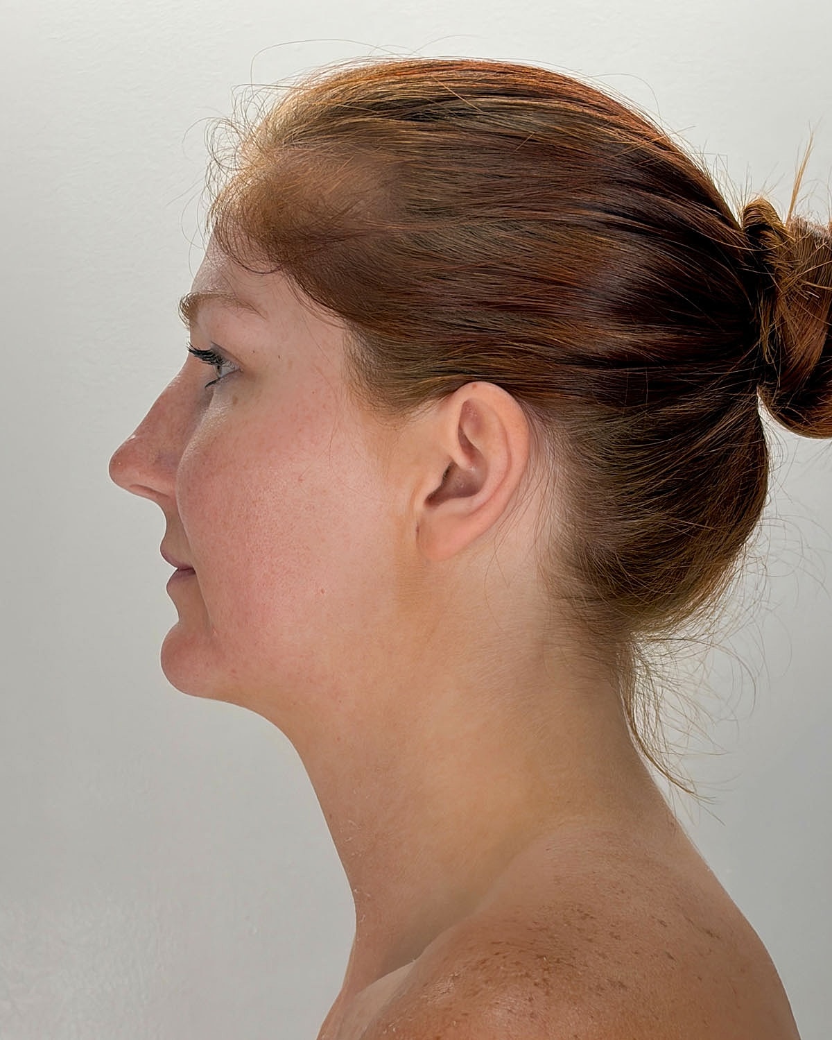 Chin Liposuction Gallery Before & After