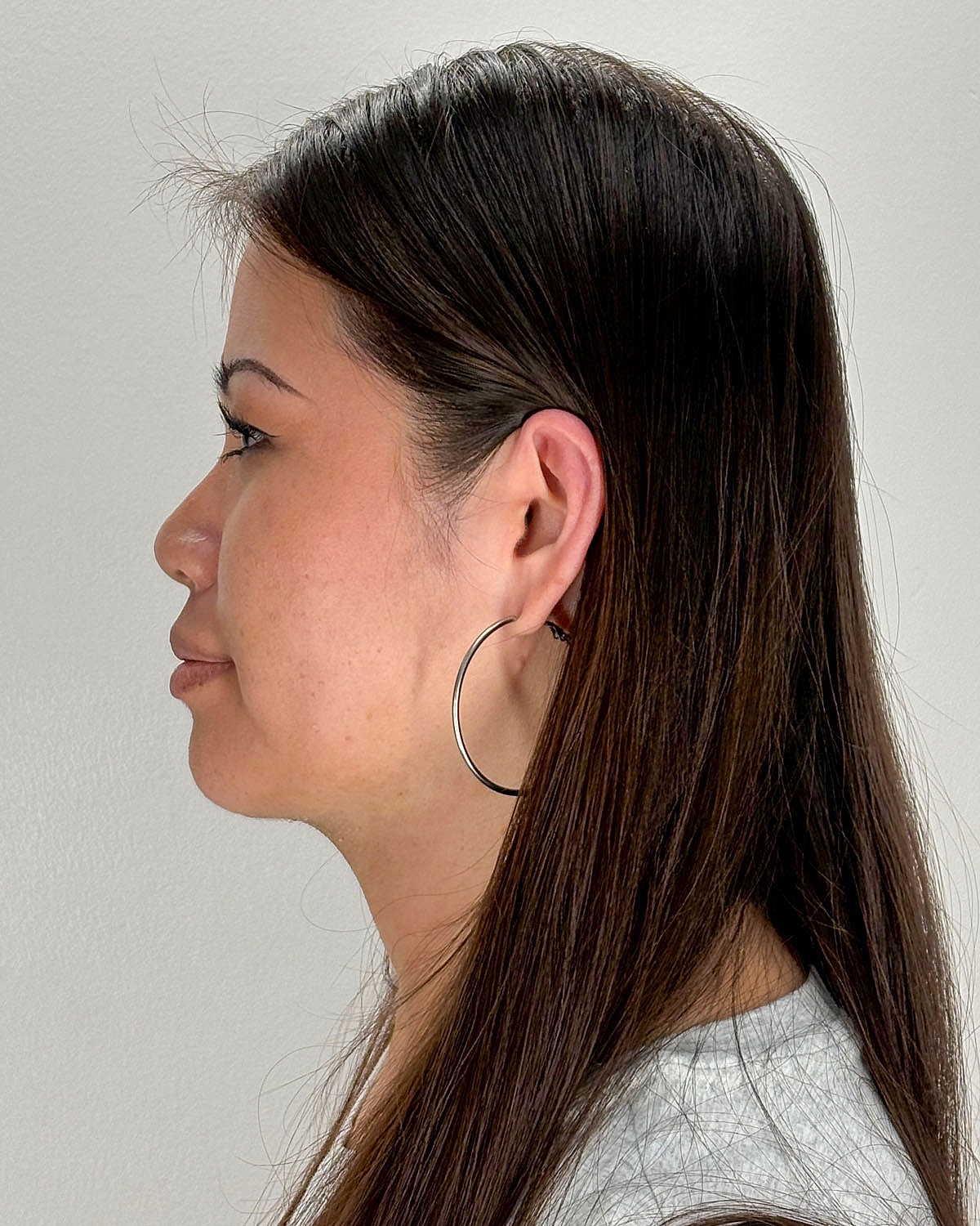 Chin Liposuction Gallery Before & After