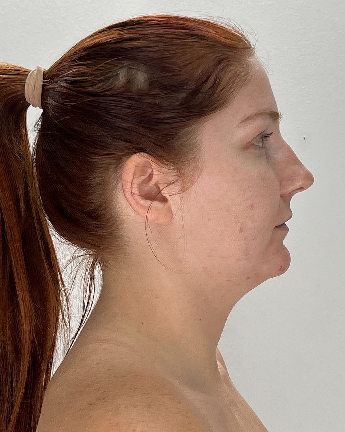 Chin Liposuction Gallery Before & After