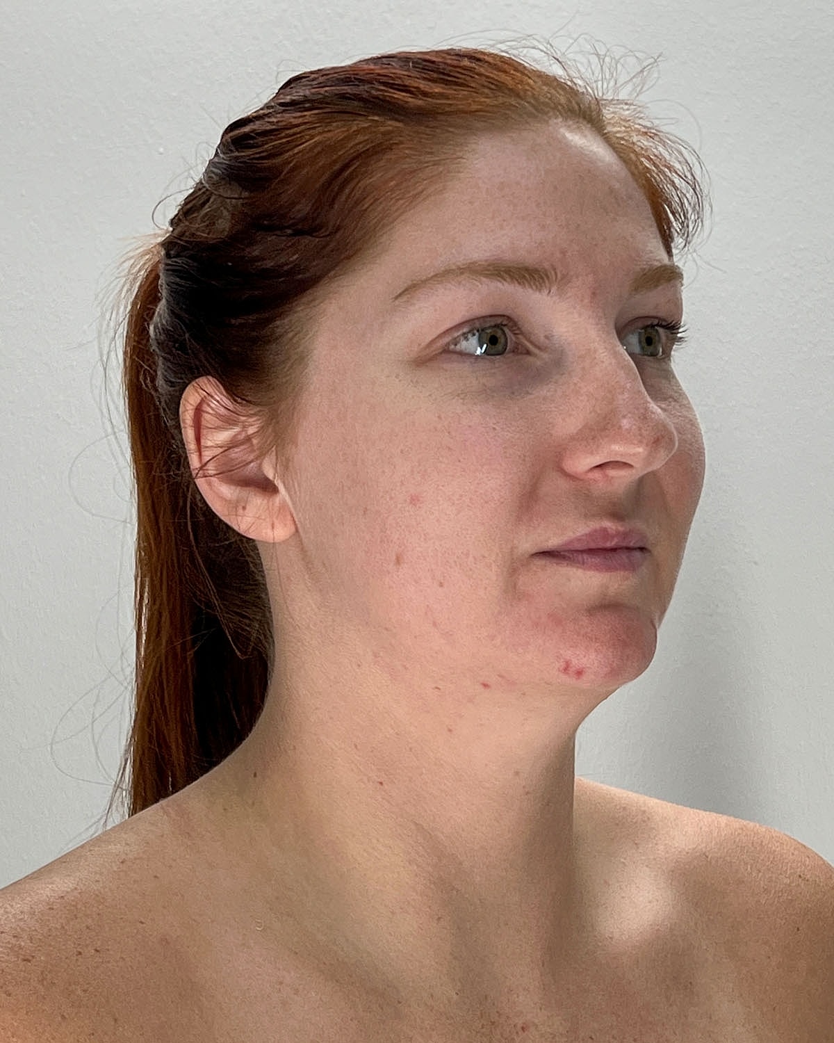 Chin Liposuction Gallery Before & After