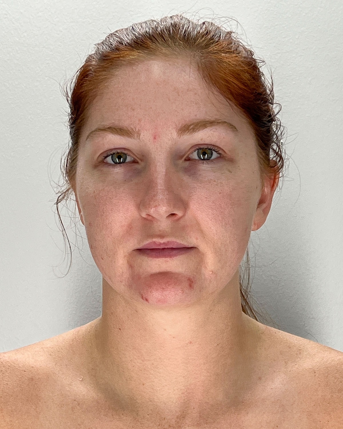 Chin Liposuction Gallery Before & After