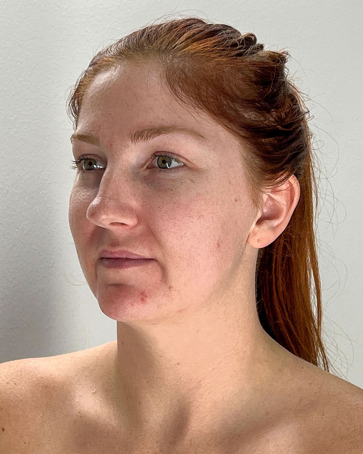 Chin Liposuction Gallery Before & After