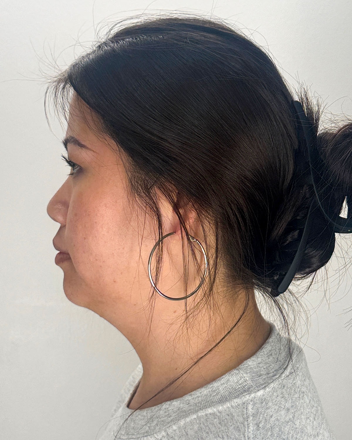 Chin Liposuction Gallery Before & After