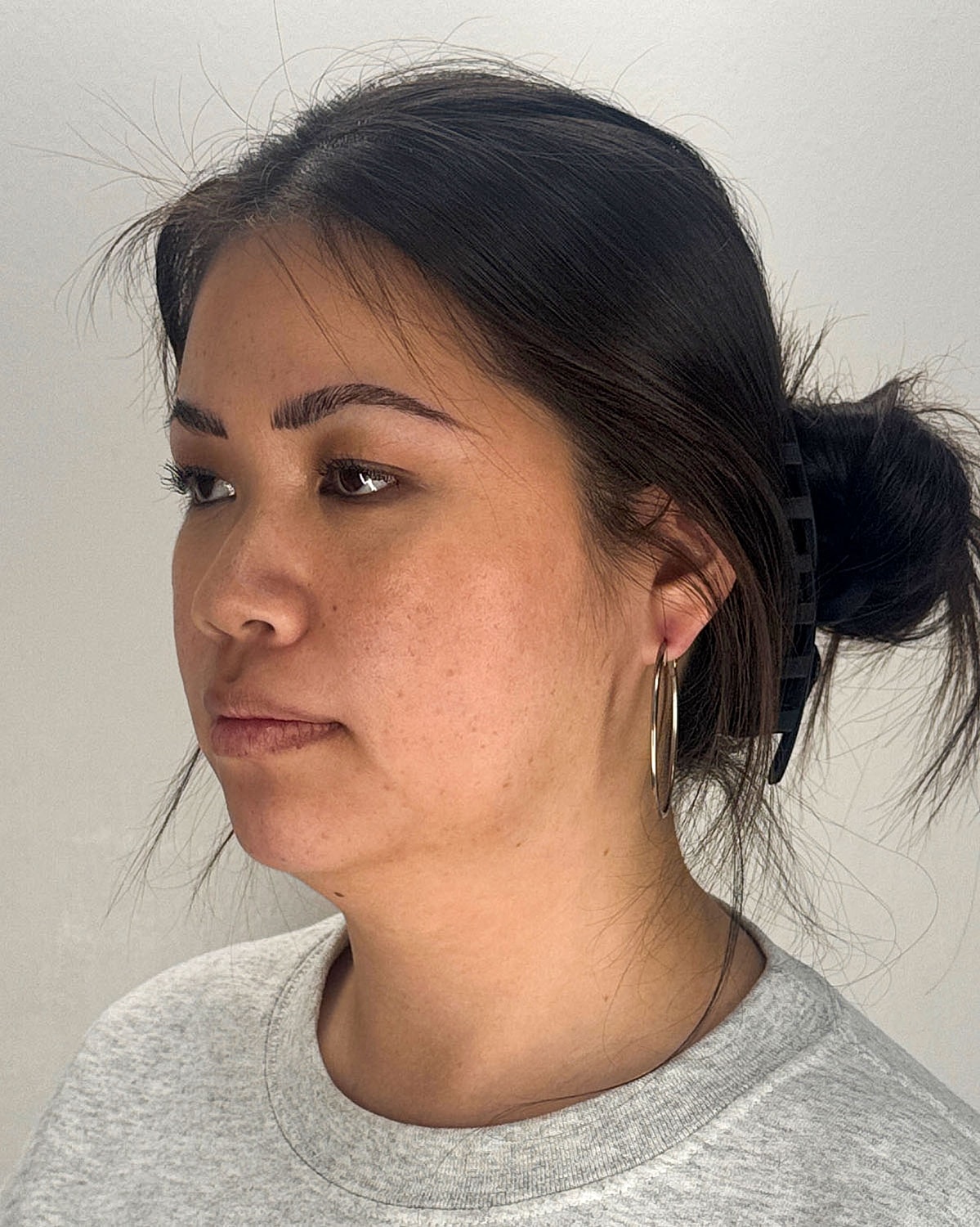 Chin Liposuction Gallery Before & After