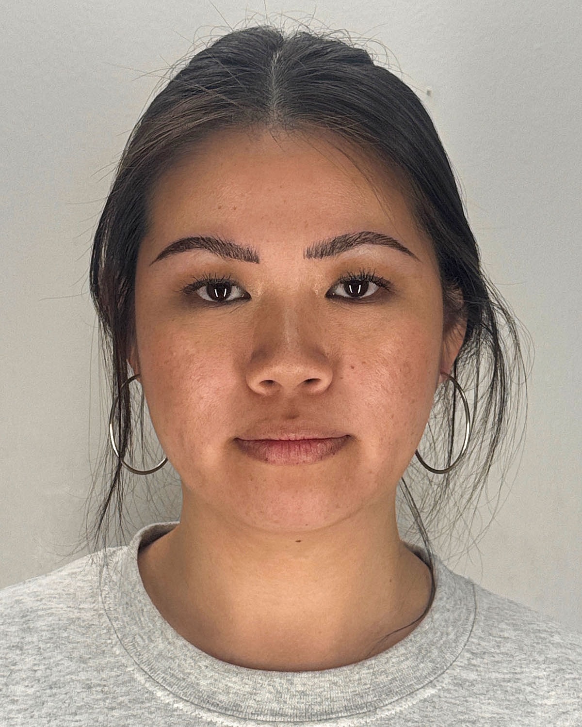 Chin Liposuction Gallery Before & After