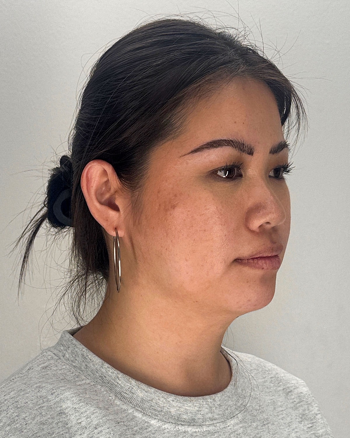 Chin Liposuction Gallery Before & After