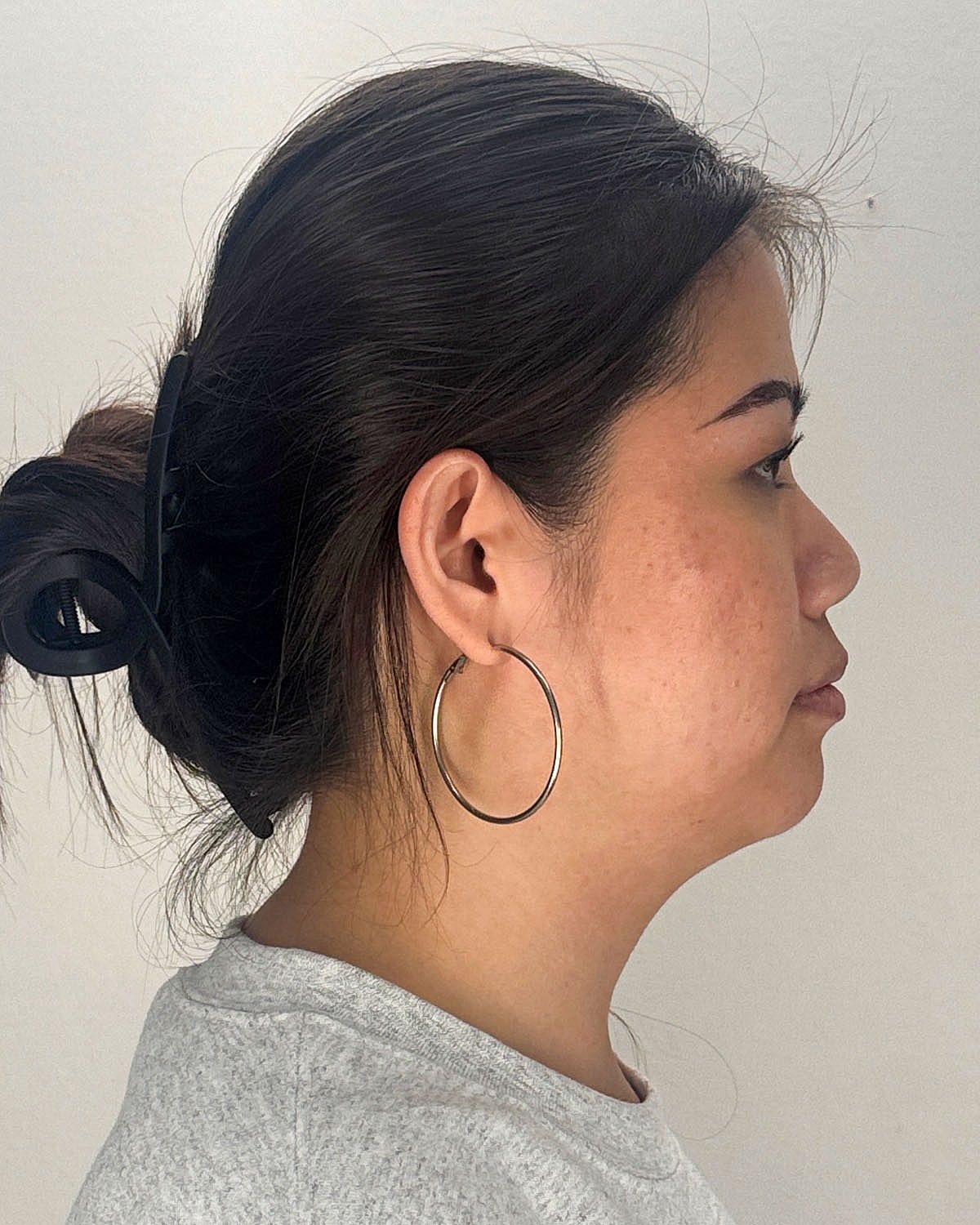 Chin Liposuction Gallery Before & After