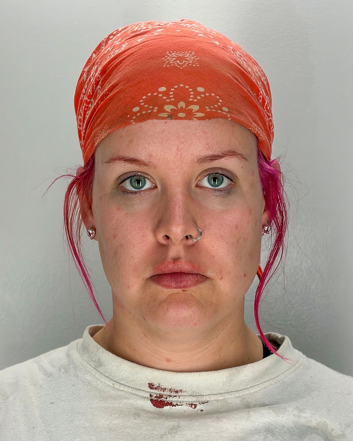 Chin Liposuction Gallery Before & After
